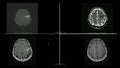 Magnetic resonance images MRI of brain infarction