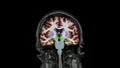 MRI brain. Alzheimer disease. Royalty Free Stock Photo