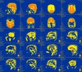 Magnetic resonance imaging of the brain