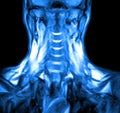 Magnetic resonance imaging of the cervical spine. Royalty Free Stock Photo