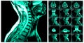 Magnetic resonance imaging of the cervical spine.