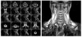 Magnetic resonance imaging of the cervical spine. Royalty Free Stock Photo