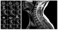 Magnetic resonance imaging of the cervical spine. Royalty Free Stock Photo