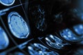 Magnetic resonance imaging of human brain with suspected cerebropathy Royalty Free Stock Photo