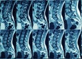 Magnetic resonance imaging of human spine Royalty Free Stock Photo