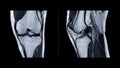 Magnetic resonance imaging of knee joint or MRI knee Royalty Free Stock Photo