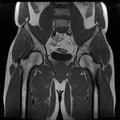 Magnetic resonance imaging of the male hip. Observed changes in osteoarthritis in the right hip