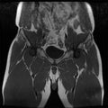 Magnetic resonance imaging of the male hip. Visible changes in osteoarthritis in the right hip Royalty Free Stock Photo