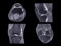 Magnetic resonance imaging or MRI knee comparison sagittal PDW and TIW view