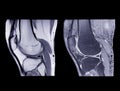 Magnetic resonance imaging or MRI knee comparison sagittal PDW and TIW view Royalty Free Stock Photo