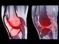 Magnetic resonance imaging or MRI knee comparison sagittal PDW and TIW view for detect tear or sprain of the anterior cruciate