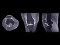 Magnetic resonance imaging or MRI of knee joint Axial ,Coronal and sagittal T2 FS for detect tear or sprain of the anterior