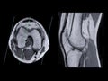 Magnetic resonance imaging or MRI of knee joint Axial and sagittal PDW for detect tear or sprain of the anterior cruciate