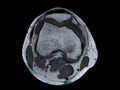 Magnetic resonance imaging or MRI of knee joint Axial view for detect tear or sprain of the anterior cruciate ligament (ACL