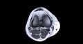 Magnetic resonance imaging or MRI of knee joint c for detect tear or sprain of the anterior cruciate ligament (ACL