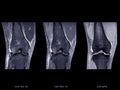 Magnetic resonance imaging or MRI of knee joint Corona; T2 FS , PDW and Gradient for detect tear or sprain of the anterior