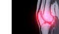 Magnetic resonance imaging or MRI of knee joint sagittal PDW . Royalty Free Stock Photo