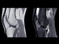 Magnetic resonance imaging or MRI of knee joint Sagittal PDW and T2 FS for detect tear or sprain of the anterior cruciate