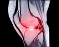 MRI knee sagittal PDW and TIW view for detect tear or sprain of the anterior cruciate  ligament & x28;ACL Royalty Free Stock Photo