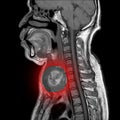 Magnetic resonance imaging MRI of neck, sagittal view, a case of neck.