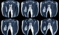 Magnetic resonance imaging MRI of right thigh Findings:fat containing mass in vastus intermedius muscle