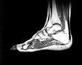 Magnetic Resonance Imaging MRI Scan of Foot/Ankle