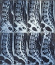 Magnetic resonance imaging or mri scan report of spinal cord or lumbar bulging, x-ray, Lumbar Spine Low Back, lower disc bone Royalty Free Stock Photo