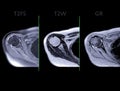 Magnetic Resonance Imaging or MRI of Shoulder Joint Axial T2FS,T2W and mFFE for diagnostic shoulder pain