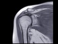 Magnetic Resonance Imaging or MRI of Shoulder Joint Coronal PDW for diagnostic shoulder pain