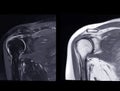 Magnetic Resonance Imaging or MRI of Shoulder Joint Coronal T2 FS and PDW for diagnostic shoulder pain