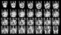 Magnetic resonance imaging MRIOF UPPER ABDOMEN of a patient who has suspected mass-forming hilar cholangiocarcinoma Coronal view