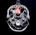 Magnetic resonance imaging of a patient with bad nose breathing, nasal congestion. The concept of hyperplasia of the