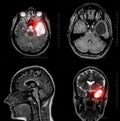 Magnetic resonance imaging of a patient with a temporal horn cyst of the left lateral ventricle of the brain. Atrophic changes in