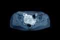 MRI Pelvic of a Healthy Woman finding Abnormalities like mass lumps.Medical healthcare concept