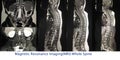 Magnetic resonance imaging of the whole spine.