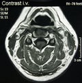 Magnetic Resonance of Neck, MR Royalty Free Stock Photo