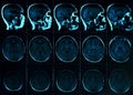Magnetic resonance scan of the brain with skull. MRI head scan on dark background blue color Royalty Free Stock Photo