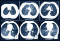 Magnetic resonance therapy of human lungs. Prevention of various diseases