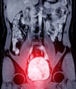 Magnetic resonance urography (MR urography) . Royalty Free Stock Photo