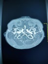 Magnetic resonance venography MRV Brain of veins in human head.