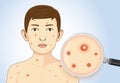 Magnifying chickenpox of children.