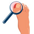 Foot with ingrown toenail.Disease, fungus or inflammation in fingernails. Royalty Free Stock Photo