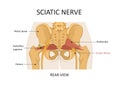 Sciatic nerve. The main causes of sciatica.