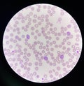 Malaria blood parasite infected red blood cells