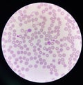 Malaria blood parasite infected red blood cells