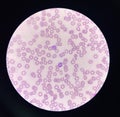 Malaria blood parasite infected red blood cells