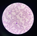 Malaria blood parasite infected red blood cells