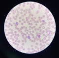 Malaria blood parasite infected red blood cells