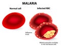 Malaria. Normal and infected red blood cells