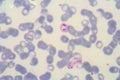 Malaria. Normal and infected red blood cells.